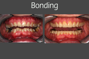 Before and after pictures of Dr. Vandewater's dental patient with bonding.