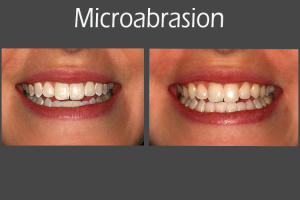 Before and after picture of a microabrasion by Ellisville dentist Dr. Jay Vandewater.