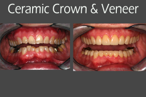 Before and after pictures of Dr. Jay Vandewater's patient with ceramic crown and veneer.