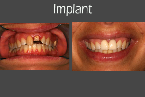 Before and after picture of a dental implant by Ellisville dentist Dr. Jay Vandewater.